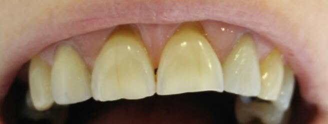 Caso de estética dental — situación inicial